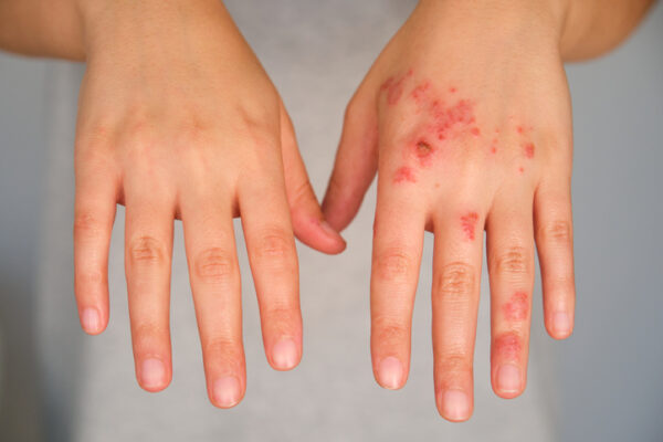 Nektar’s Novel Eczema Drug Meets Trial Goals, But Differentiation From Dupixent Remains Unclear