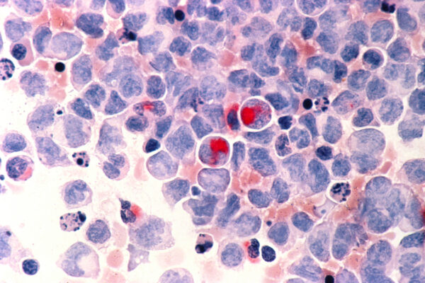 Kura Oncology Drug’s Data at ASCO Support FDA Filing Now Under Priority Review for Leukemia