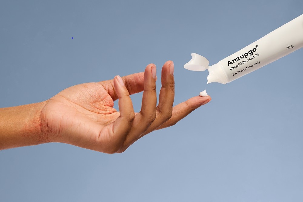 LEO Pharma Topical Cream Is Now the First FDA-Approved Drug for Chronic Hand Eczema