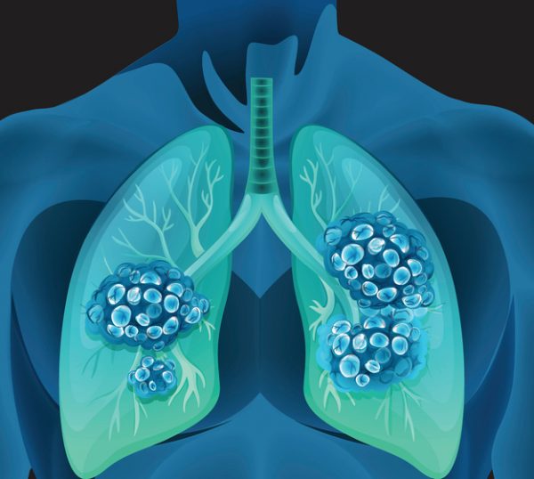 Summit Lung Cancer Drug Falls Short on Key Survival Goal in Global Study, Putting FDA Approval in Doubt