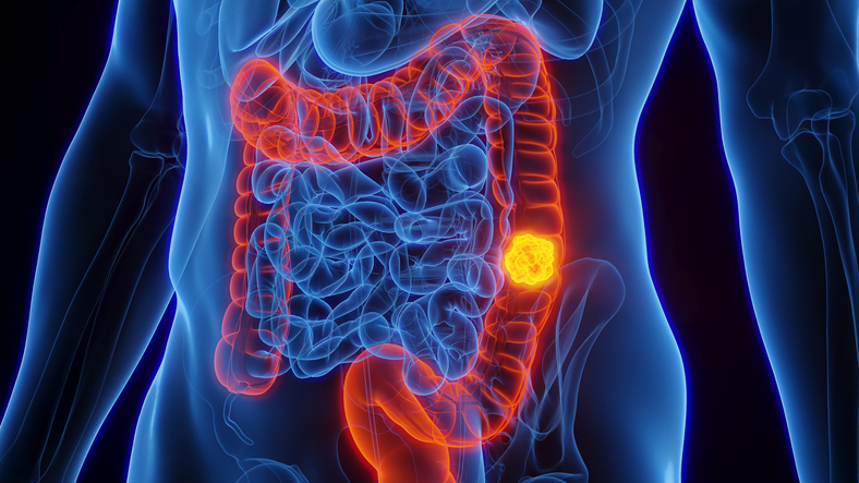 Cartography Bio Corrals $67M to Bring Targeted Colorectal Cancer Drug Into the Clinic